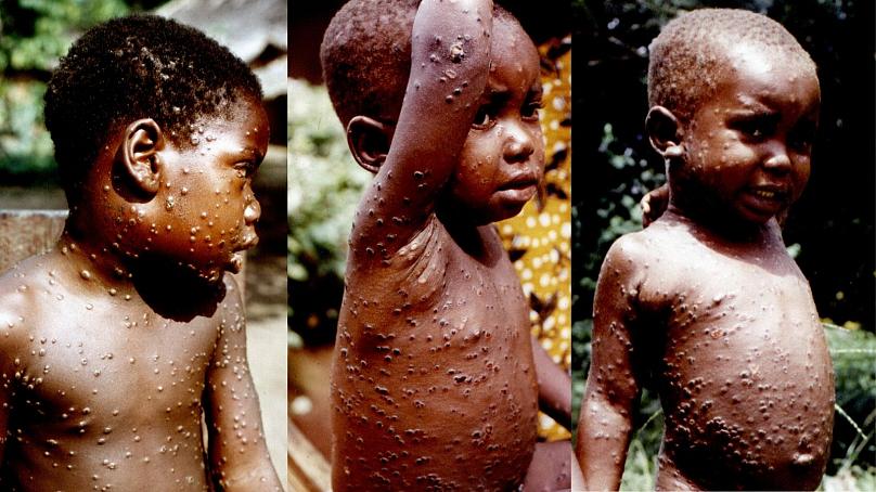 Children in Africa suffering from Monkeypox
