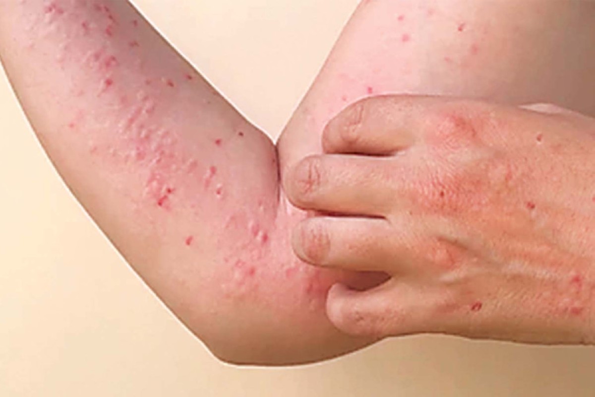 Philippines detects 2 more new cases of mpox