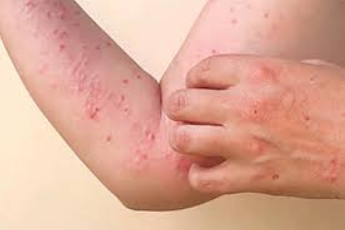 Philippines reports 2 more mpox cases, raising total to 5