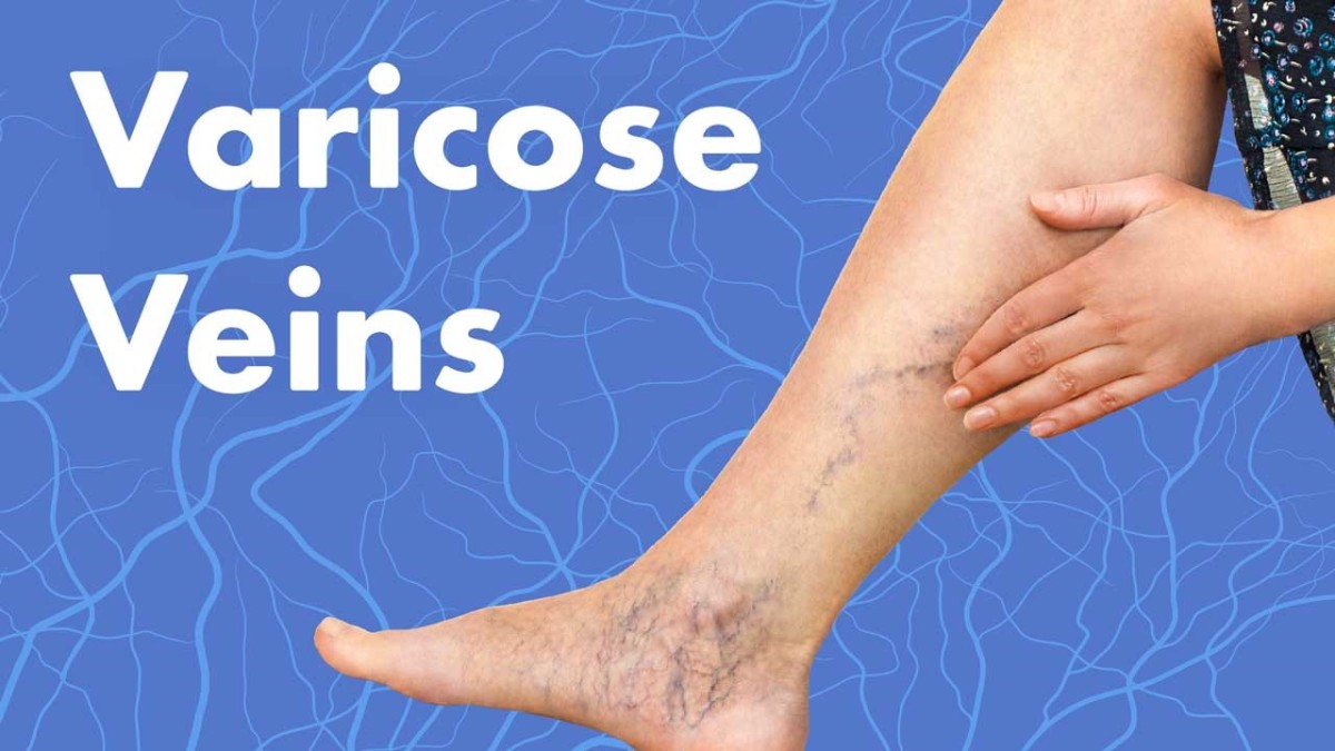 Ignoring varicose veins can impair your quality of life