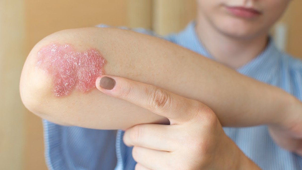 Psoriasis Affects Over 76,000 in Kuwait as Patients Await Cure