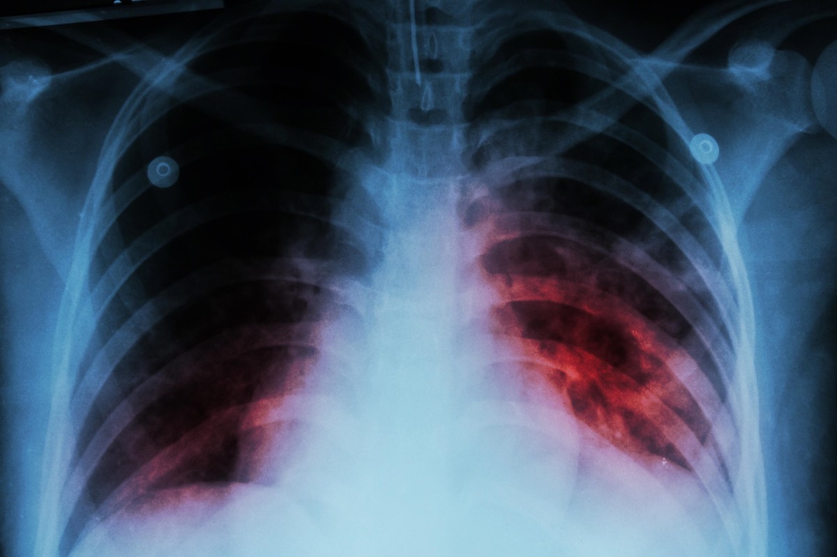 Tuberculosis becomes leading cause of infectious disease deaths in 2023: WHO
