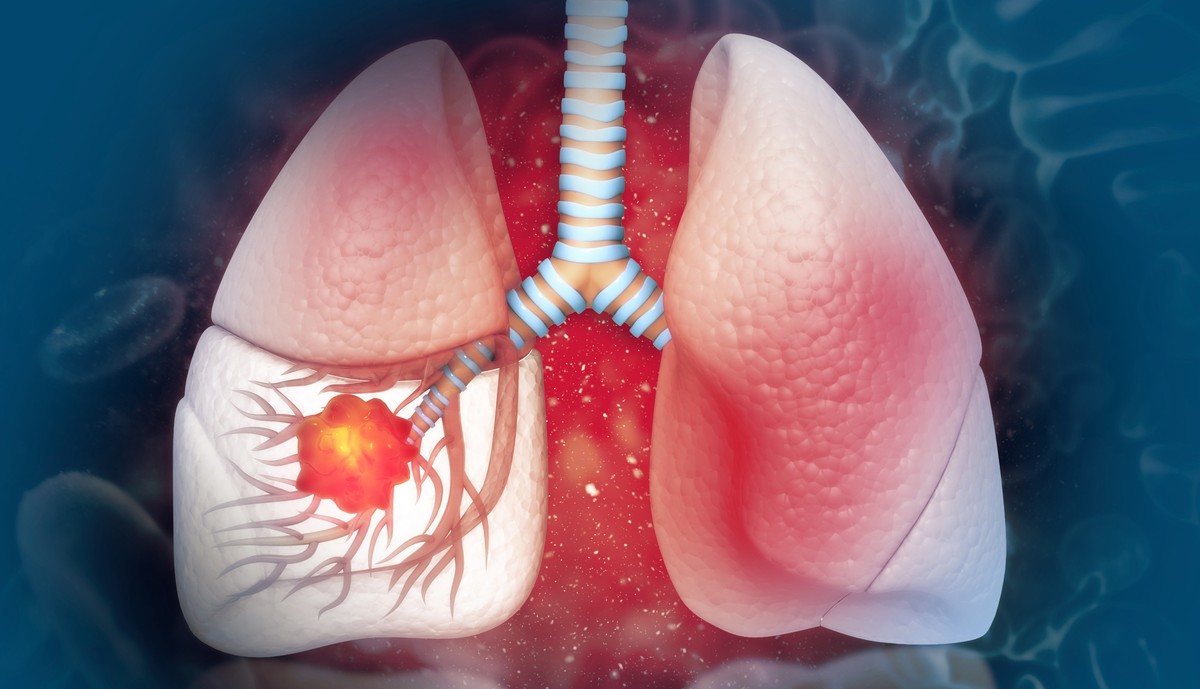Lung cancer: Early warning signs and how to protect yourself