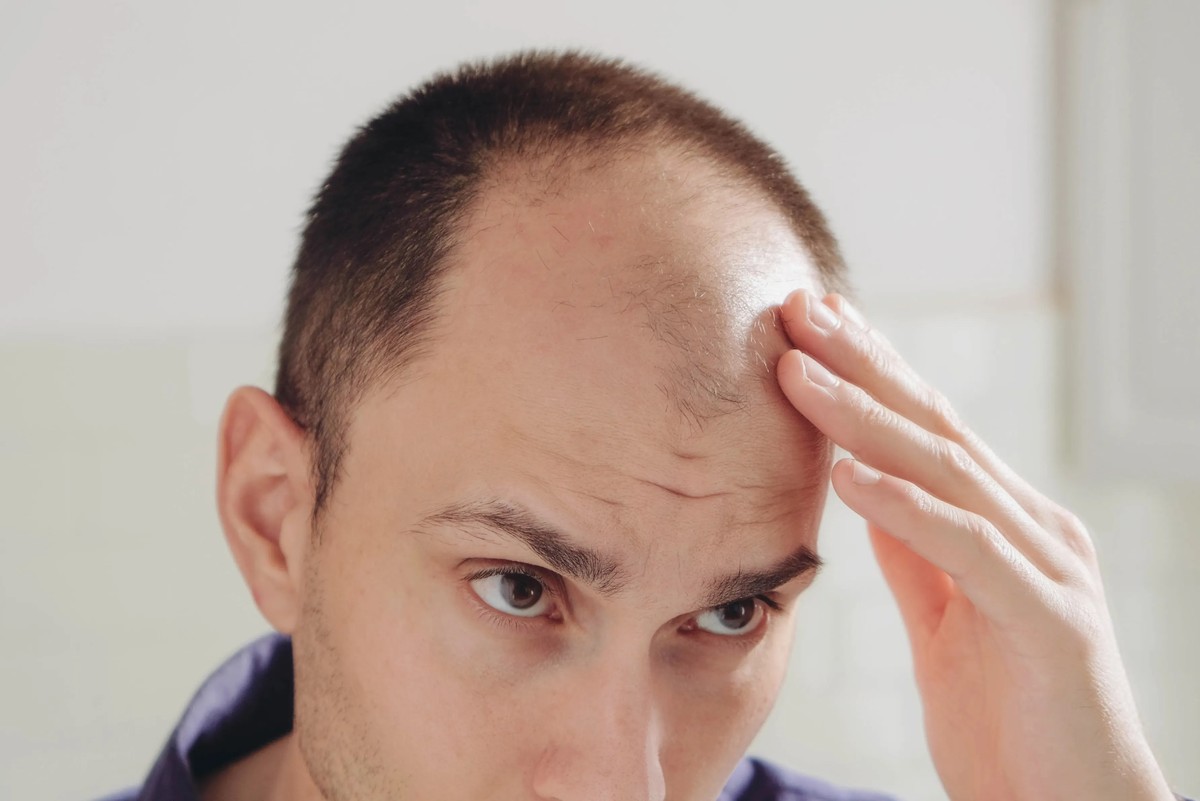 Sugared gel shows potential in reversing hair loss: new study