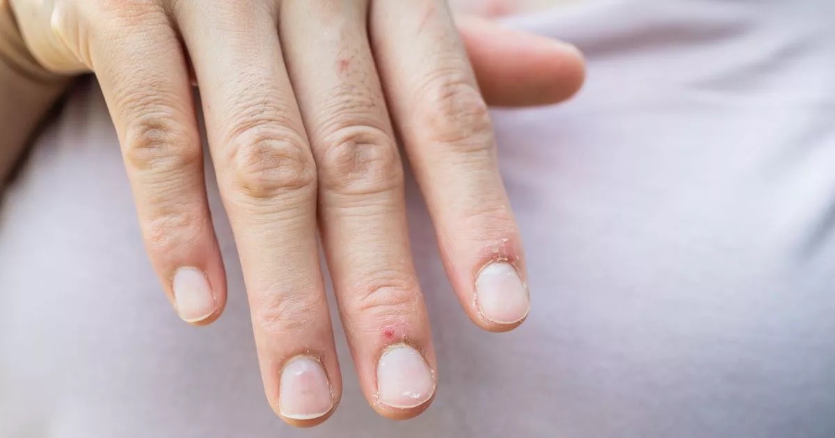 Nail changes may point to lung cancer, expert warns