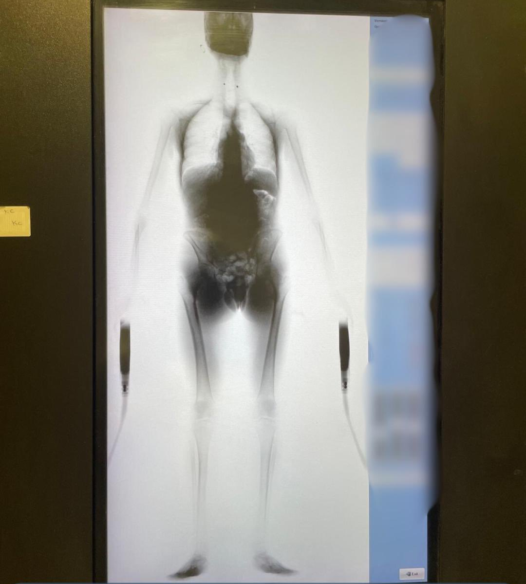 European Drug Mule Caught At Kuwait Airport With Hashish Hidden In His Stomach