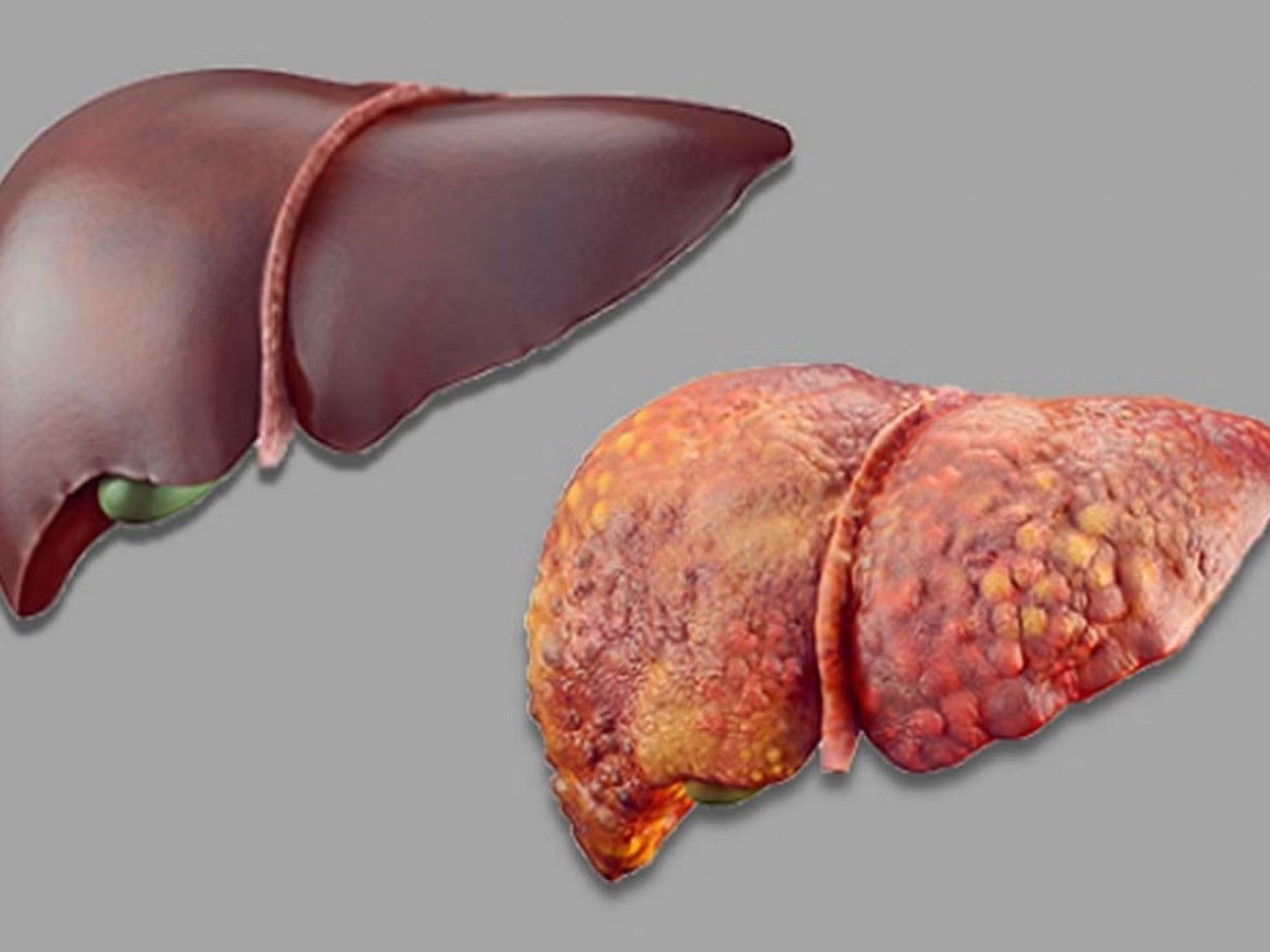 Common vegetables may prevent and reverse fatty liver disease