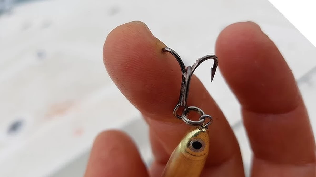 Fishing Hook Lodged in Man&rsquo;s Face