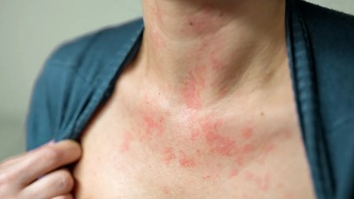 Keto diet blamed for red, itchy rash in case study