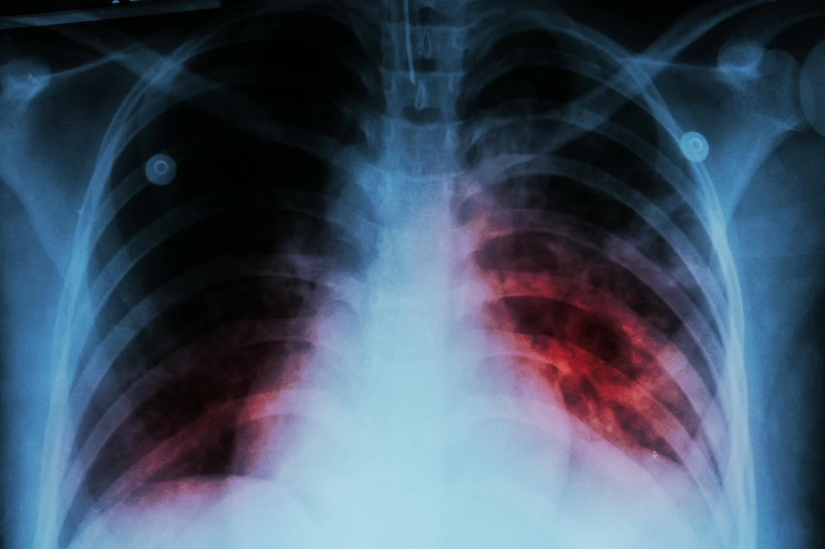 New study shows promise against drug-resistant TB