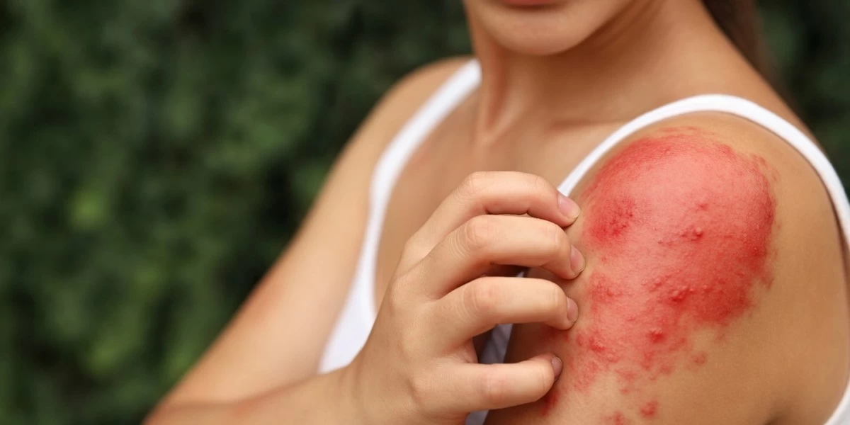 Rising temperatures during summer could disrupt natural balance of skin, causing surge in dermatological issues