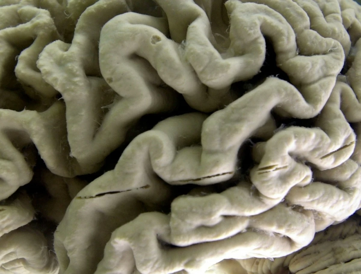 Study shows blood test can help identify healthy people at high risk for Alzheimer's disease