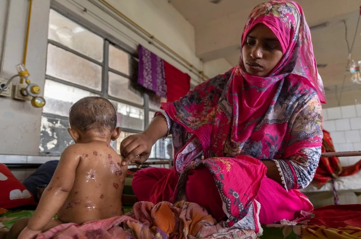 Bangladesh Records More Than 1,000 New Measles Cases in 24 Hours