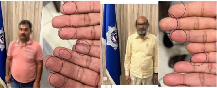 Surgical Alteration of Fingerprints Foiled, 2 Asians Arrested