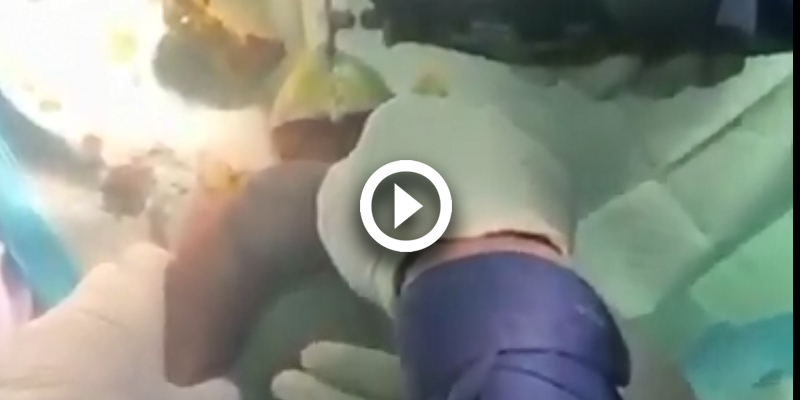 Woman’s hand freed from meat mincer